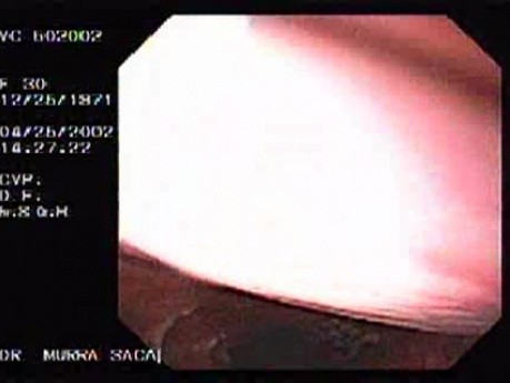 Full Colonoscopy (2 of 4)