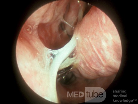 Acute Viral Rhinitis Second Stage