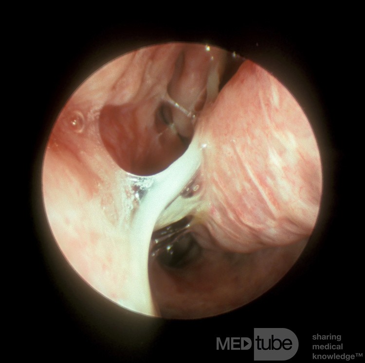 Acute Viral Rhinitis Second Stage