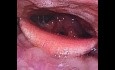 Bilateral Vocal Cord Leukoplakia with Sings of Laryngopharyngeal Reflux (LPR)