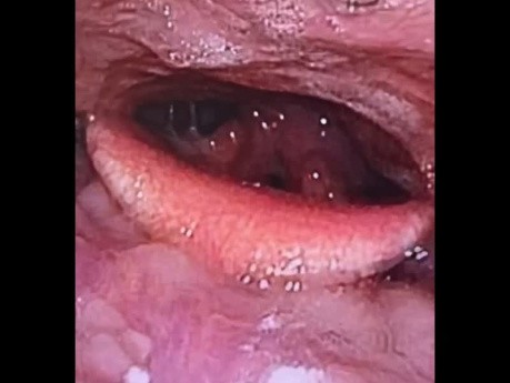 Bilateral Vocal Cord Leukoplakia with Sings of Laryngopharyngeal Reflux (LPR)