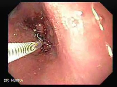 Adenocarcinoma of the middle third (3 of 5 )
