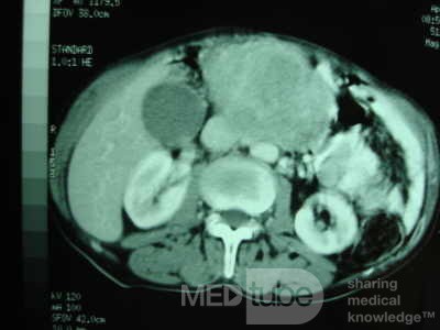 Gastric Ulcer with Gastrocolic fistula due to a Zollinger-
 Ellison Syndrome (31 of 33)