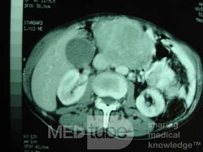 Gastric Ulcer with Gastrocolic fistula due to a Zollinger-
 Ellison Syndrome (31 of 33)