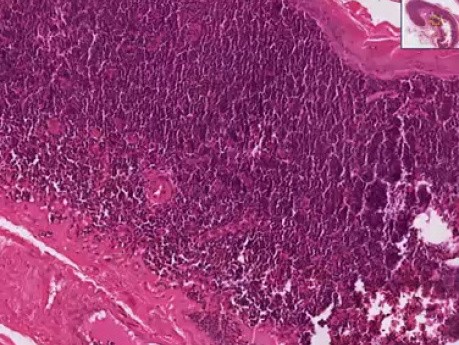 Branchial cyst (lymphoepithelial cyst) - Histopathology of neck