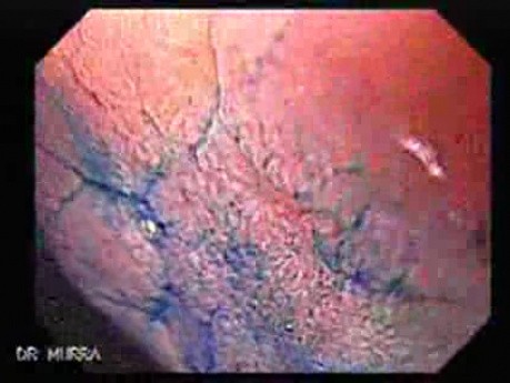 Chronic Gastritis (6 of 8)