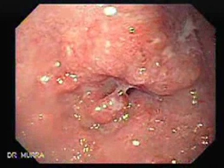 Adenocarcinoma of the Middle Third of Esophagus - 47 Years-Old Woman with Dysphagia