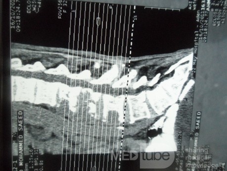 Pancreas cancer - 12