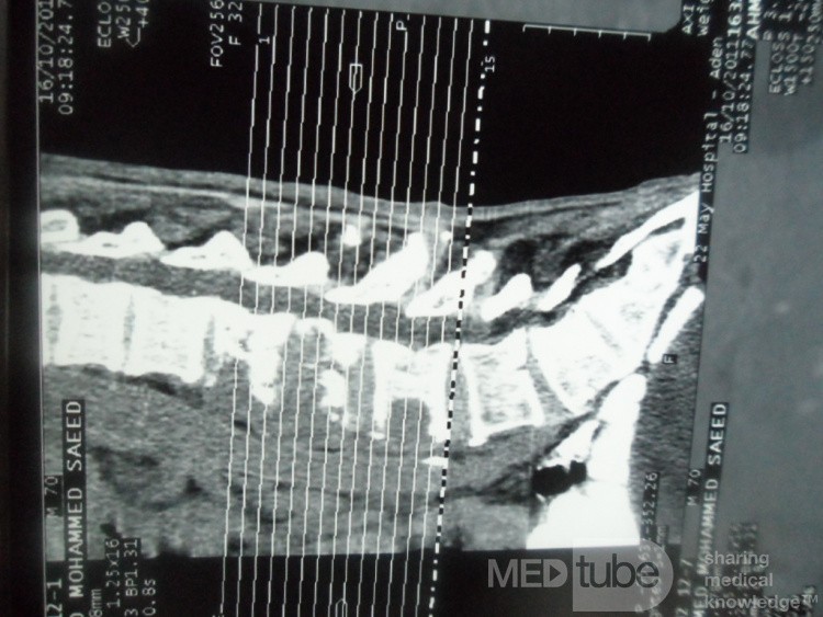 Pancreas cancer - 12