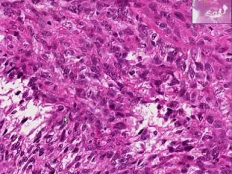 Leiomyosarcoma