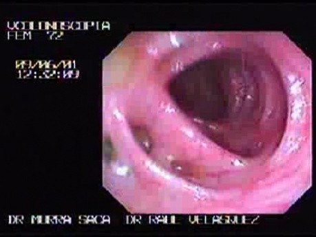 Colostomy (Hartmann´s procedure) (2 of 3)