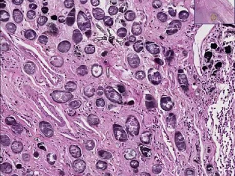 Schistosomiasis
