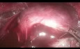 TOETVA - Transoral Endoscopic Thyroidectomy, Vestibuler Approach