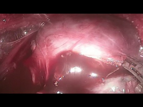 TOETVA - Transoral Endoscopic Thyroidectomy, Vestibuler Approach