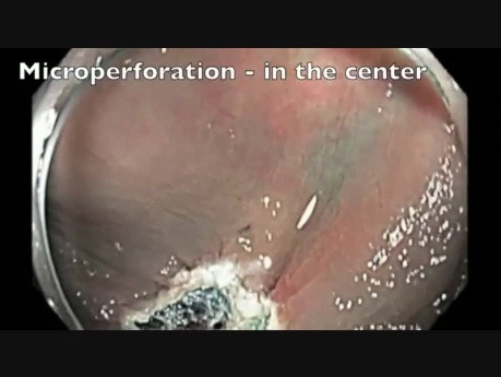 Colon EMR Perforation Analysis-F
