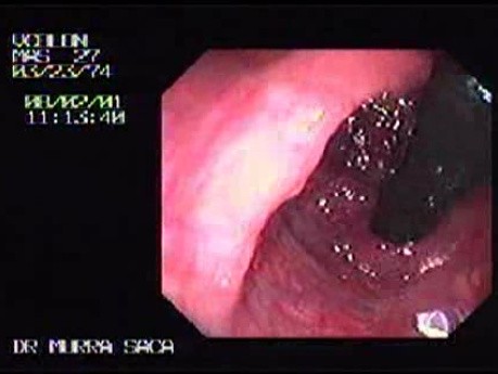 Familial Adenomatous Polyposis of the Colon (19 of 29)