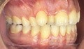 Orthodontic Case, What Treatment Plan?