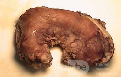 Plastic Linitis with bilateral Krukenberg´s tumor (8 of 13)