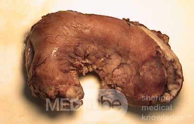 Plastic Linitis with bilateral Krukenberg´s tumor (8 of 13)