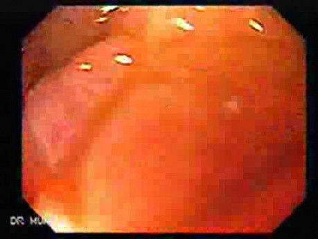 Scirrhous Gastric Carcinoma -  Lugol's Stain (7 of 15)