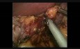 Resleeve After Technical Procedure Mistake with Weight Loss Absence