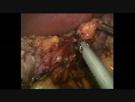 Resleeve After Technical Procedure Mistake with Weight Loss Absence