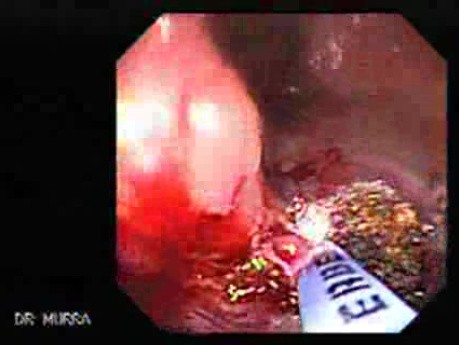 Cap Polyposis (5 of 7)