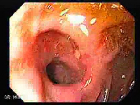 Choledocoduodenostomy and The Sump Syndrome (2 of 10)