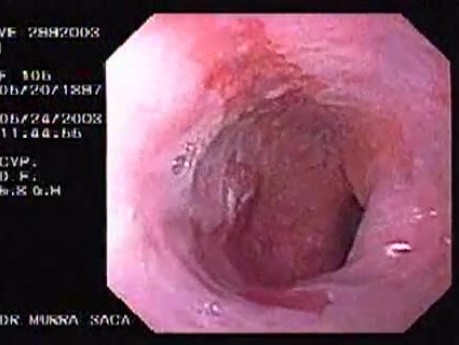 Barret´s Esophagus long segment (1 of 4)