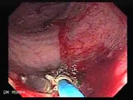 Endoscopic Resection of Giant Tubulo-Villous of the rectum (33 of 35)
