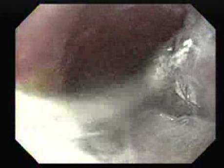 Achalasia - Presence of Residual Saliva