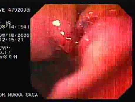 Intraluminal Endoscopic Suturing - Assessment of the First Gastroplicature, Part 1