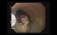 EFTR - Endoscopic Full Thickness Resection