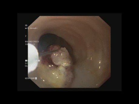 EFTR - Endoscopic Full Thickness Resection