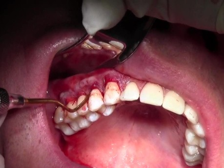 Gingival Grafting #3-6 Sites