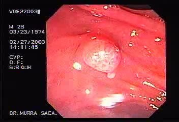 Rectum (23 of 30)