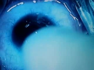 Keratoconus - Intacs Insertion - 2