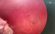 Intramyometrial Cyst (Adenomyosis)