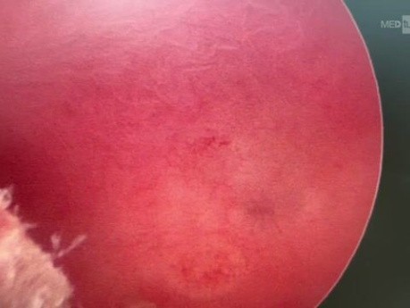 Intramyometrial Cyst (Adenomyosis)