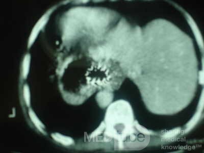 Palliation of Dysphagia of Esophageal Cancer by Endoscopic Lumen Restoration with Intraluminal tumor Debulking (18 of 18)