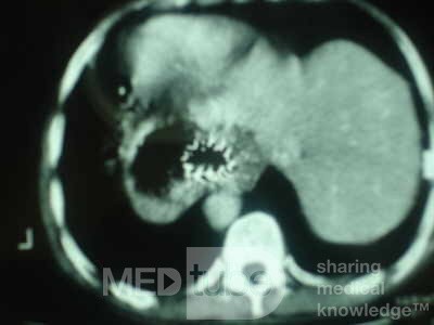 Palliation of Dysphagia of Esophageal Cancer by Endoscopic Lumen Restoration with Intraluminal tumor Debulking (18 of 18)