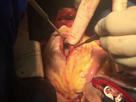 Patient with Huge LV Aneurysm And LV Clot Mobile and LVEF 10