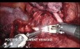 S2 Segmentectomy (Robotic)