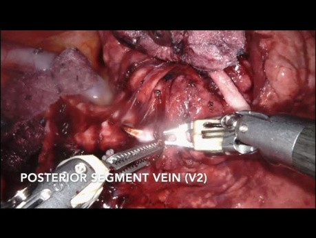S2 Segmentectomy (Robotic)