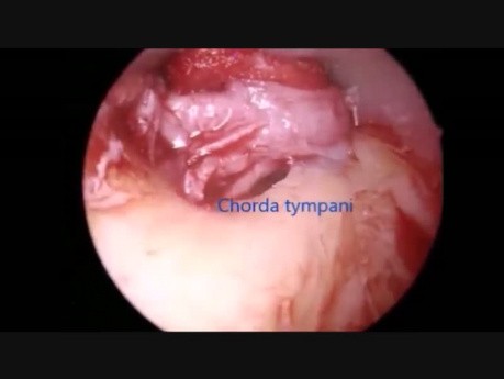 Endoscopic Stapedectomy