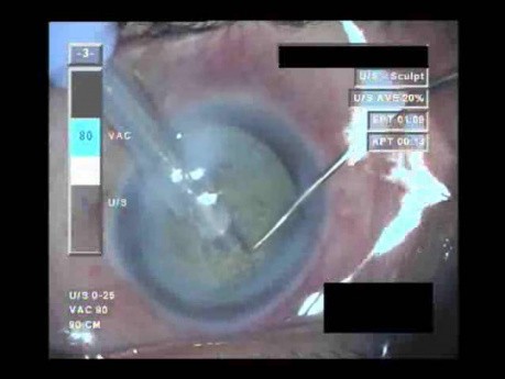 Cataract Surgery I - 2