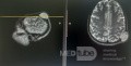 Epicranial Tumor Injury