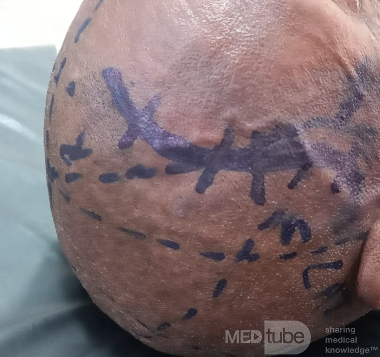 Low-grade Astrocytomas, Clinical Case of 70 y/o Male