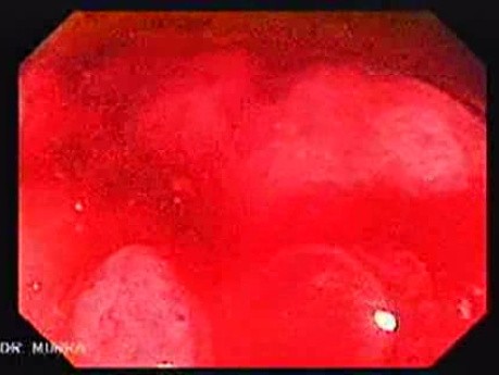 Rectal Adenocarcinoma (6 of 12)