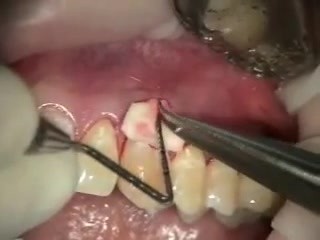 How To Deal With Recessions - Purified Collagen Implant